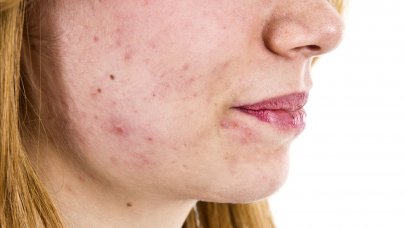 Woman with light acne