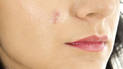 Woman with pimple
