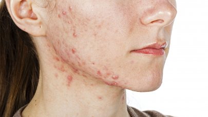 Woman with acne