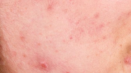 Acne skin